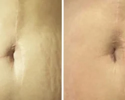 1needpro skin treatment